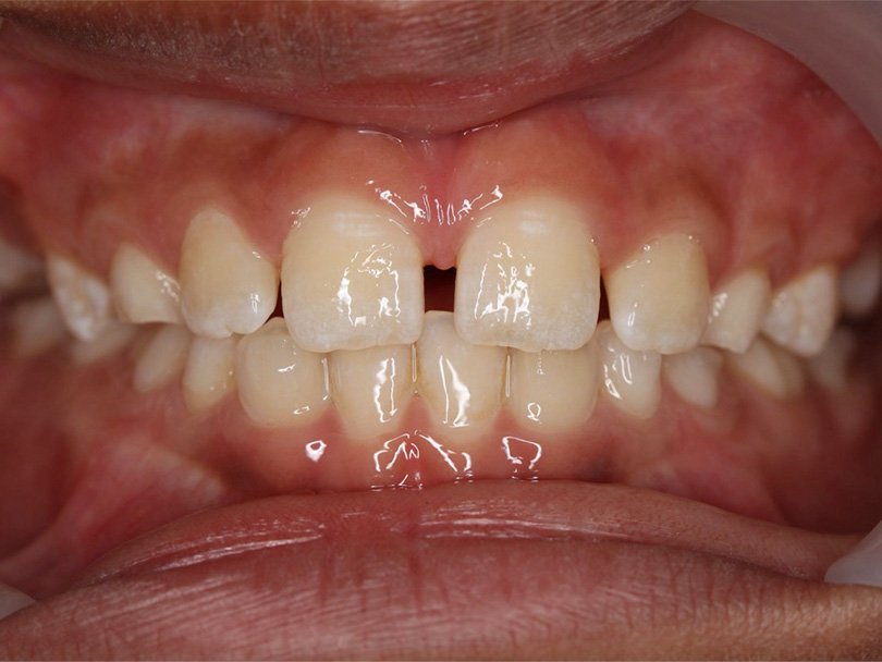 Vorher / Nachher Vergleiche von kieferorthopÃ¤dischen Behandlungen