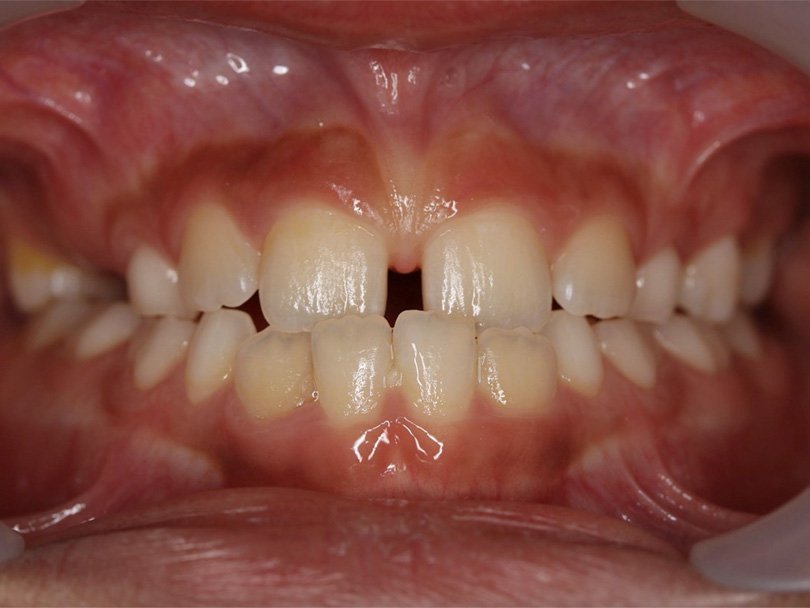 Vorher / Nachher Vergleiche von kieferorthopÃ¤dischen Behandlungen