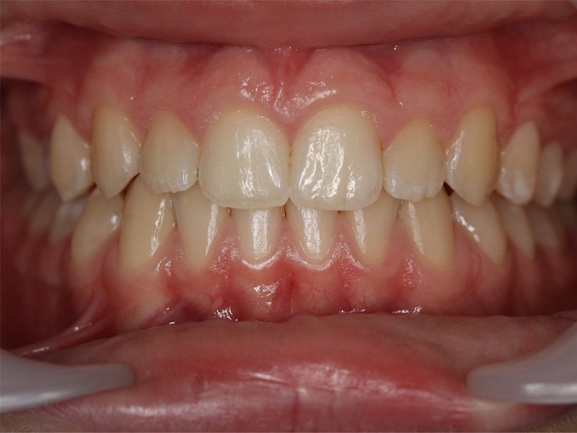 Vorher / Nachher Vergleiche von kieferorthopÃ¤dischen Behandlungen