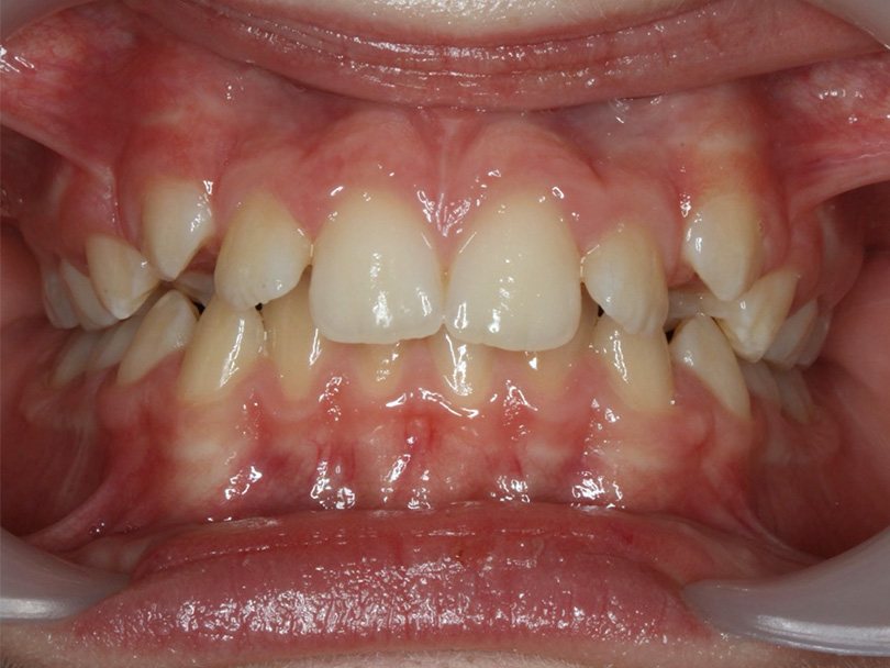 Vorher / Nachher Vergleiche von kieferorthopÃ¤dischen Behandlungen
