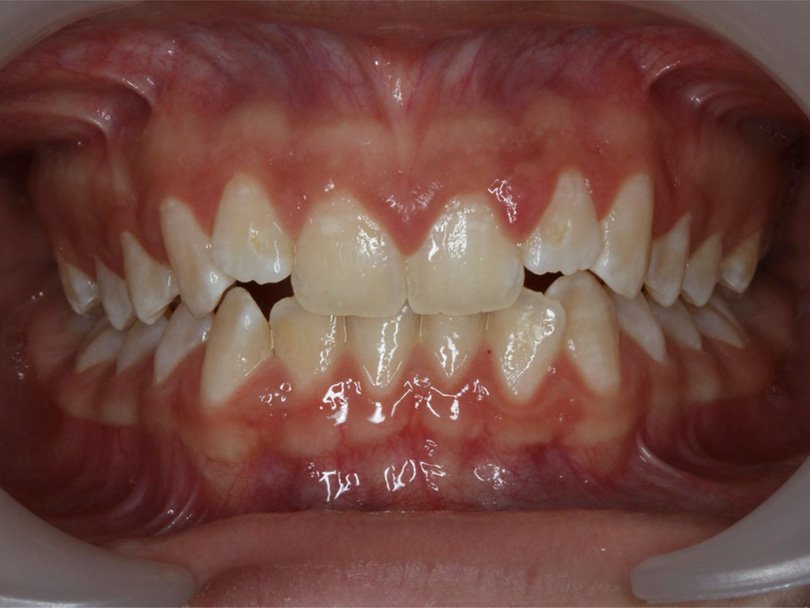 Vorher / Nachher Vergleiche von kieferorthopÃ¤dischen Behandlungen