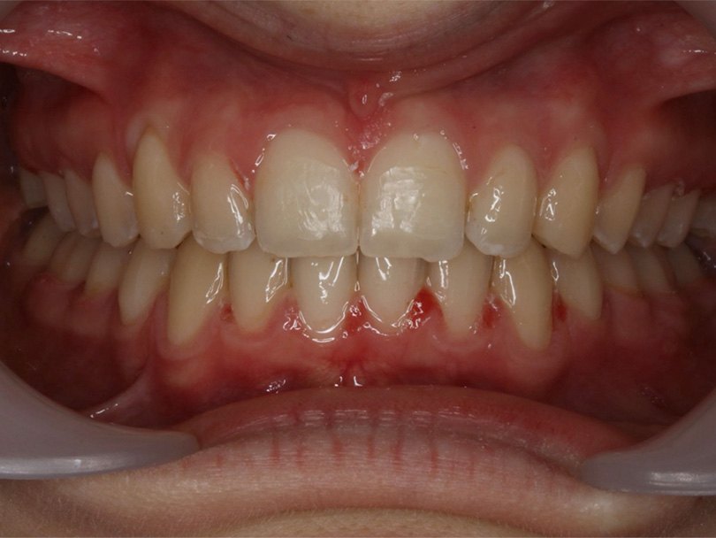 Vorher / Nachher Vergleiche von kieferorthopÃ¤dischen Behandlungen