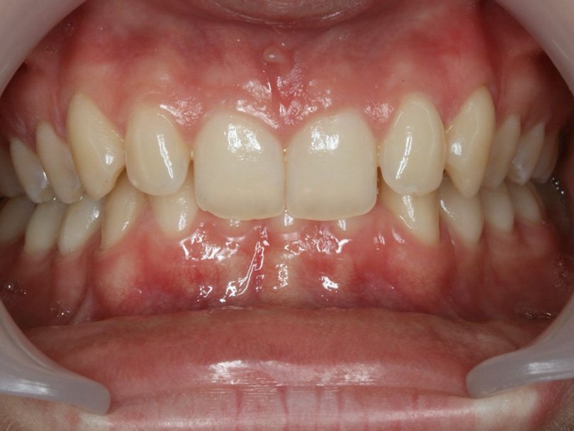 Vorher / Nachher Vergleiche von kieferorthopÃ¤dischen Behandlungen