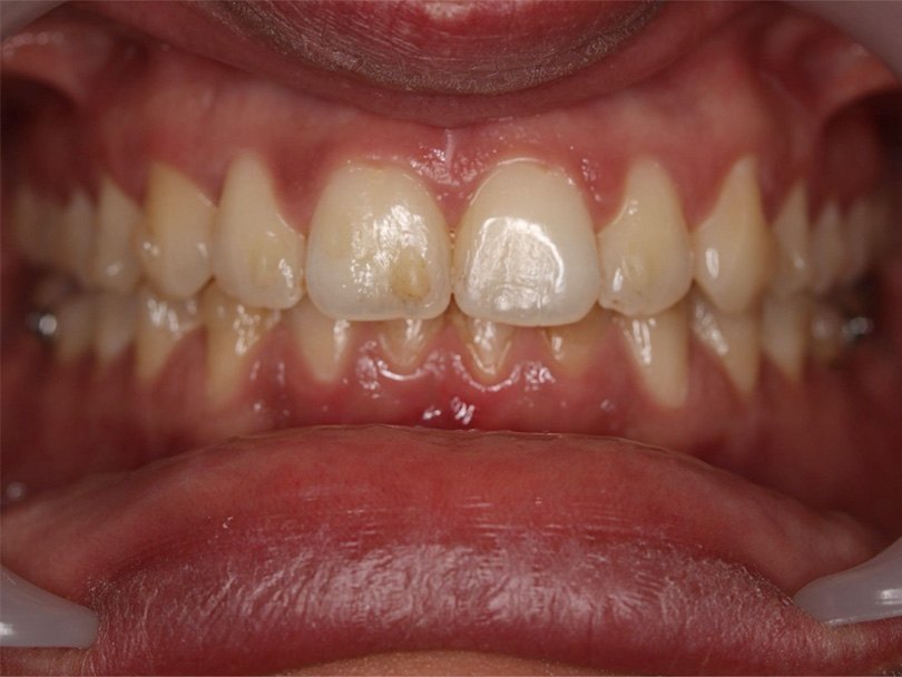 Vorher / Nachher Vergleiche von kieferorthopÃ¤dischen Behandlungen