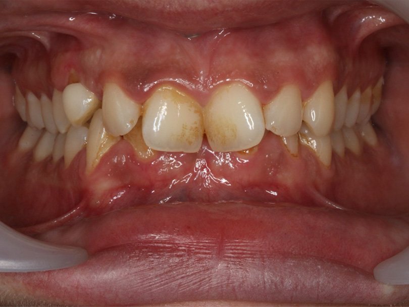 Vorher / Nachher Vergleiche von kieferorthopÃ¤dischen Behandlungen