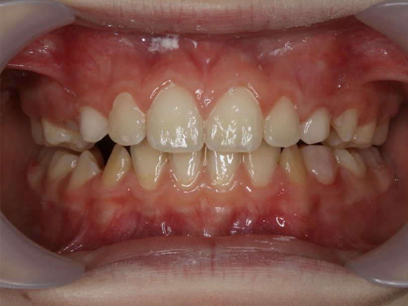 Vorher / Nachher Vergleiche von kieferorthopÃ¤dischen Behandlungen