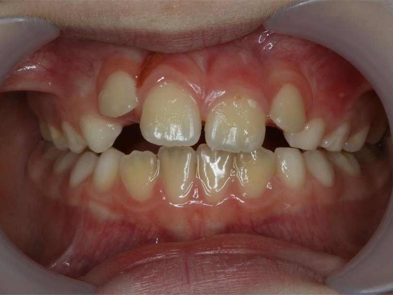 Vorher / Nachher Vergleiche von kieferorthopÃ¤dischen Behandlungen