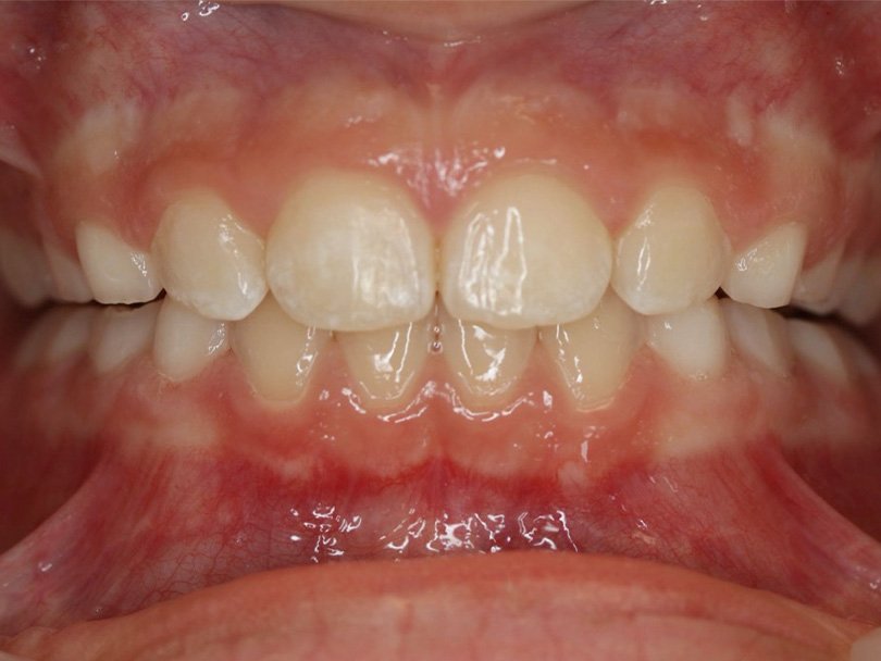 Vorher / Nachher Vergleiche von kieferorthopÃ¤dischen Behandlungen
