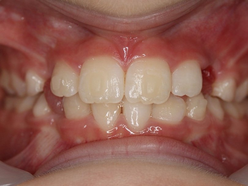 Vorher / Nachher Vergleiche von kieferorthopÃ¤dischen Behandlungen