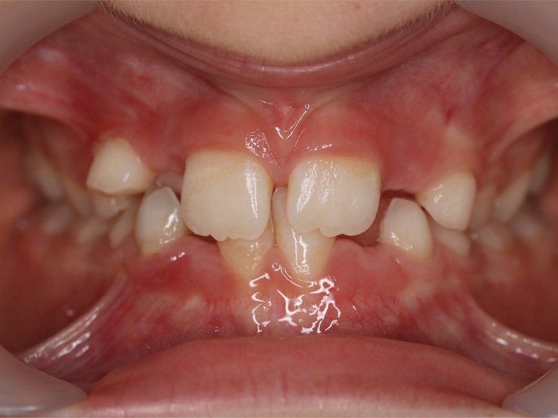 Vorher / Nachher Vergleiche von kieferorthopÃ¤dischen Behandlungen