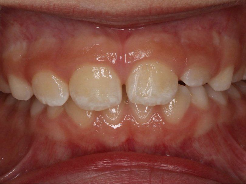 Vorher / Nachher Vergleiche von kieferorthopÃ¤dischen Behandlungen