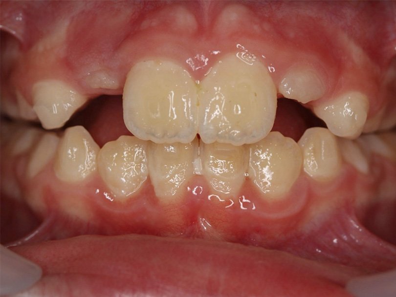 Vorher / Nachher Vergleiche von kieferorthopÃ¤dischen Behandlungen