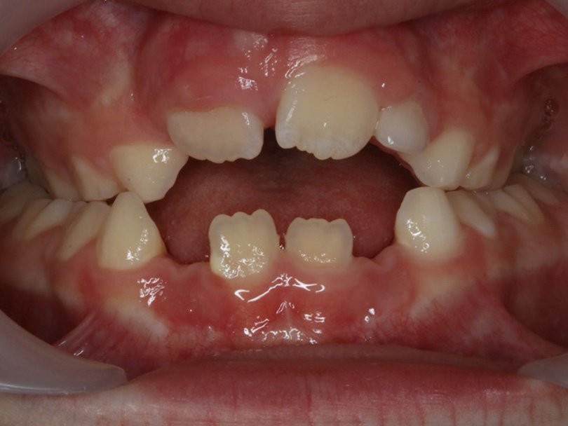 Vorher / Nachher Vergleiche von kieferorthopÃ¤dischen Behandlungen