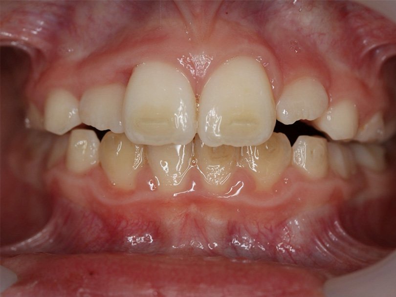 Vorher / Nachher Vergleiche von kieferorthopÃ¤dischen Behandlungen