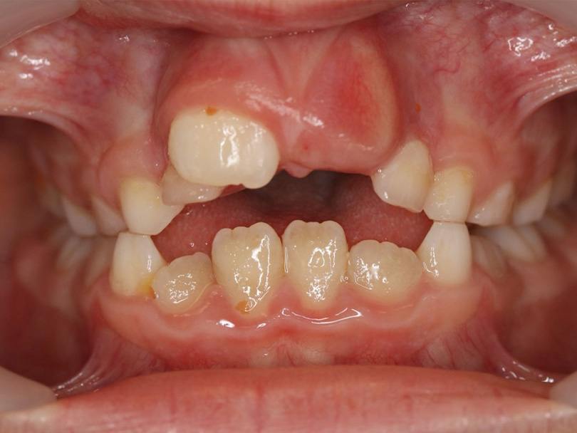 Vorher / Nachher Vergleiche von kieferorthopÃ¤dischen Behandlungen