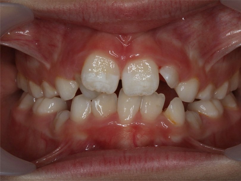 Vorher / Nachher Vergleiche von kieferorthopÃ¤dischen Behandlungen