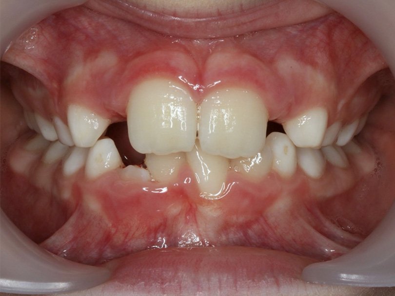 Vorher / Nachher Vergleiche von kieferorthopÃ¤dischen Behandlungen