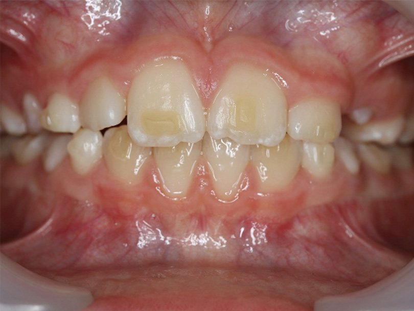 Vorher / Nachher Vergleiche von kieferorthopÃ¤dischen Behandlungen