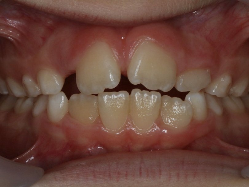 Vorher / Nachher Vergleiche von kieferorthopÃ¤dischen Behandlungen